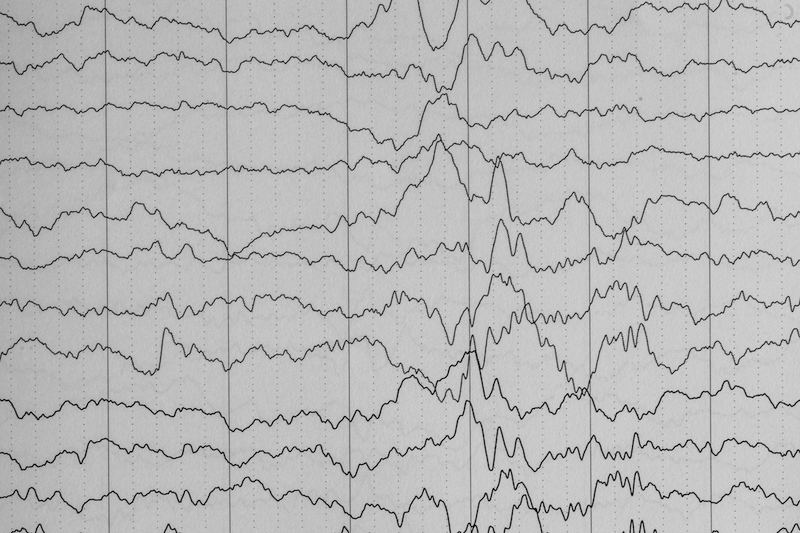 Understanding epilepsy